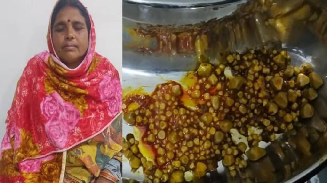 महिला के पेट से निकली 382 पथरियां