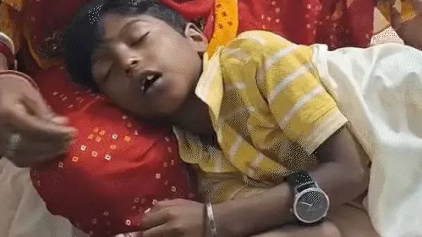 वाराणसी: स्कूल में 7 साल के बच्चे पर गिरी खौलती दाल, 30% झुलसा, टीचर बोलीं -'घर में जलता तो क्या करती, अब जाओ इलाज कराओ'