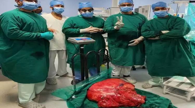 डॉक्टरों ने पेट से निकाला 30 किलो का ट्यूमर, मरीज का चलना-फिरना हो गया था दुश्वार