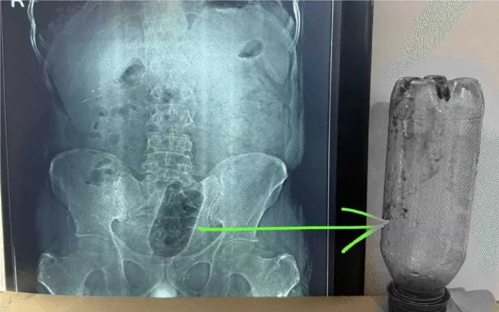 आगरा में हैरान करने वाला मामला: युवक के मलाशय में फंसी बोतल, डेढ़ घंटे की सर्जरी के बाद निकाली