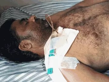 वाराणसी में घर के बरामदे में सो रहे छात्र पर एसिड फेंका: तड़के 3 बजे अटैक, चीख सुन दौड़े परिजन; अस्पताल में भर्ती