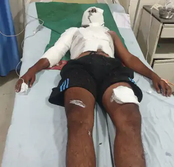 वाराणसी में घर के बरामदे में सो रहे छात्र पर एसिड फेंका: तड़के 3 बजे अटैक, चीख सुन दौड़े परिजन; अस्पताल में भर्ती
