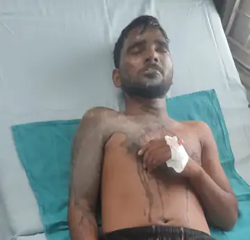 वाराणसी में घर के बरामदे में सो रहे छात्र पर एसिड फेंका: तड़के 3 बजे अटैक, चीख सुन दौड़े परिजन; अस्पताल में भर्ती