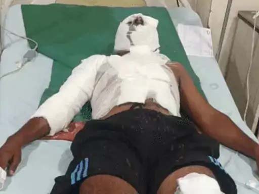 वाराणसी में रिश्तों को शर्मसार करने वाली वारदात: घर के बाहर सो रहे युवक पर फेंका तेजाब, चचेरा भाई गिरफ्तार; प्रेम-प्रसंग से जुड़ा है मामला